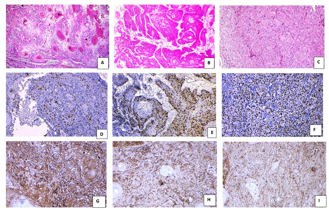 Photomicrograph showingl A: Well differentiated; B: Moderately differentiated and C: Poorly differentiated oral squamous cell carcinoma (H&E 100x); D: Well differentiated oral squamous cell carcinoma showing immunopositivity for Ki-67 score-1; E: Moderately differentiated oral squamous cell carcinoma showing immunopositivity for Ki-67 score-2; F: Poorly differentiated oral squamous cell carcinoma showing immunopositivity for Ki-67 score- 3; G: Well differentiated oral squamous cell carcinoma showing immunopositivity for CD44 score-4; H: Moderately differentiated oral squamous cell carcinoma showing immunopositivity for CD44 score-2; I: Poorly differentiated oral squamous cell carcinoma showing immunopositivity for CD44 score-2 (IHC 400x) respectively.