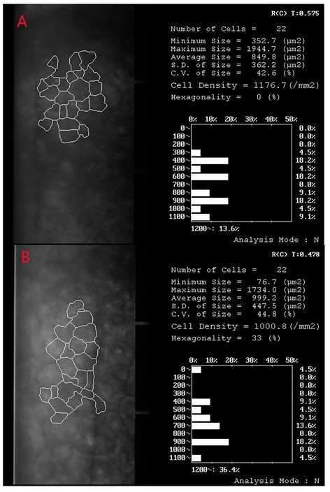 Density of corneal endothelial cells before (A) and 5 days after surgery (B) in a patient who had the history of trabeculectomy and received PPL as the technique of cataract extraction