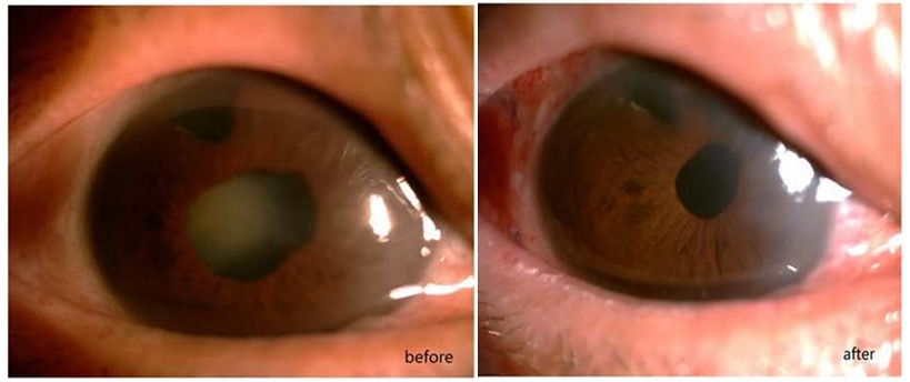 Slitlamp examination before (A) and 5 days after surgery (B) in the same patient who had the history of trabeculectomy and received PPL as the technique of cataract extraction.