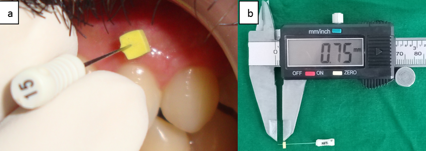 a: Placement of endodontic spreader with rubber stopper; b: Measurement of gingival thickness using digital vernier caliper.