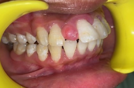 After 2 week of scaling and curettage