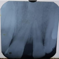 I.O.P.A. radiograph showing Interdental bone loss. 