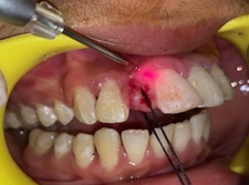 Excision by laser
