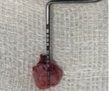 Excised tissue