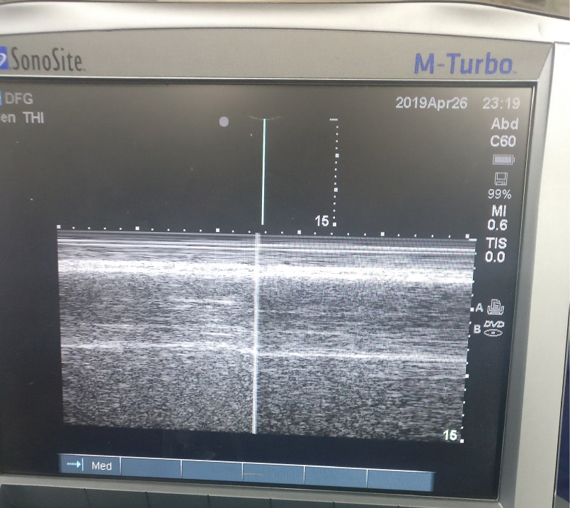 Ultrasound of the diaphragm using M mode.