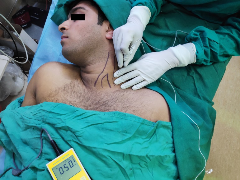 Patient positioning and landmarks while performing PNS guided ISBPB.