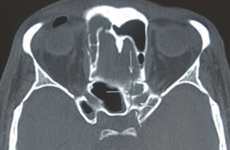 Radiograph  Axial CT image showing planum fracture