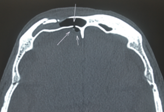 Ragiograph  Axial CT image showing frontal sinus fracture