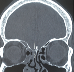 Radiograph  Coronal CT image showing cribriform plate fracture