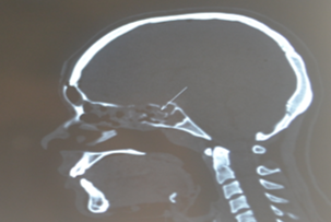 Radiograph Sagittal CT image showing Pitutitarysellar floor fracture