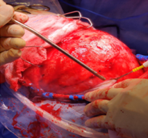 Operative Harvesting of Pericranial Flap being done proximal to scalp incision so as to get enough Flap area for ACF base repair.