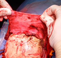 Operative Pedicled Pericranial Flap lifted from the underlying frontal bone.