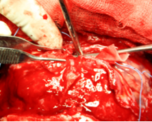 Operative Durotomy with ligation of Superior Sagittal Sinus close to Skull base