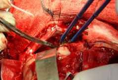 Operative Dynamic frontal lobar retraction to inspect the defect and minimize lobar retraction injury.