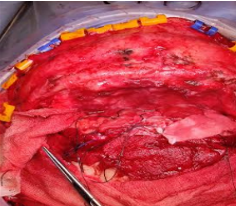 Operative  ACF Base covered with PedicledPericranial flap by rolling it over the entire ACF base.