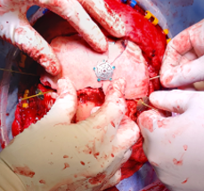 Operative  Free bone flap being fixed