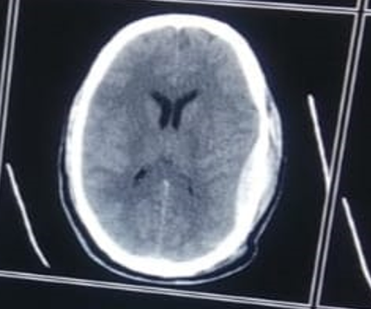 Left parietal acute SDH with 8mm thickness.