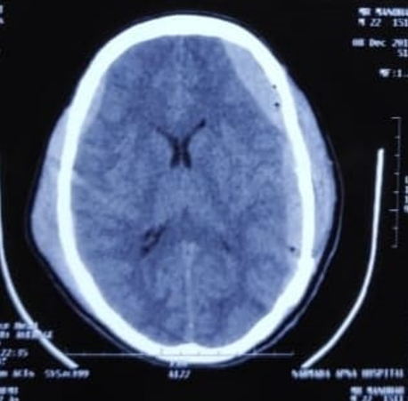 Left frontoparietotemporal acute SDH with pneumocephalus with 2mm midline shift.