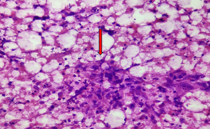 FNAC finding showing granulomatous lymphadenitis with necrosis. (H &E stain 400X)