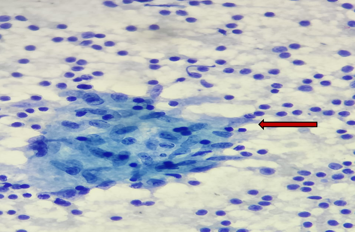 FNAC findings are showing granulomatous lymphadenitis without necrosis. (PAP stain,400X)