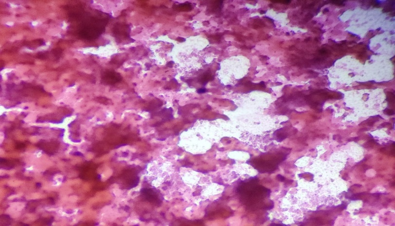 FNAC shows wide areas of necrosis. (PAP stain,100X)