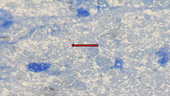 FNAC findings show the presence of AFB against a necrotic background in ZN staining. (Oil immersion,1000X)