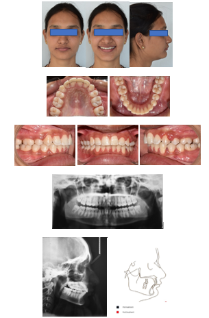 Post treatment photos and radiographs of the patient; Superimposition of cephalometric tracings pre-treatment (black) and post treatment (red). 