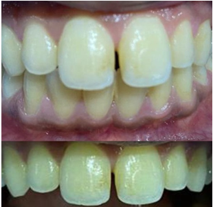 Relapsed midline diastema.
