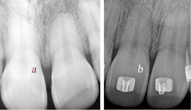 a) Periapical radiograph with noticeable amount of root resorption before orthodontic treatment. b) Periapical radiograph after closure of midline diastema.
