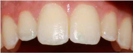Closure of midline diastema in between maxillary central incisors.
