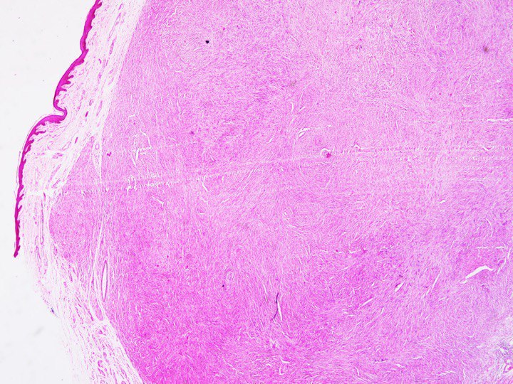 Haematoxylin & Eosin (H&E, 100X) section shows a skin lined tissue with anunencapsulated, partially circumscribed spindle cell tumour seen in the dermis.