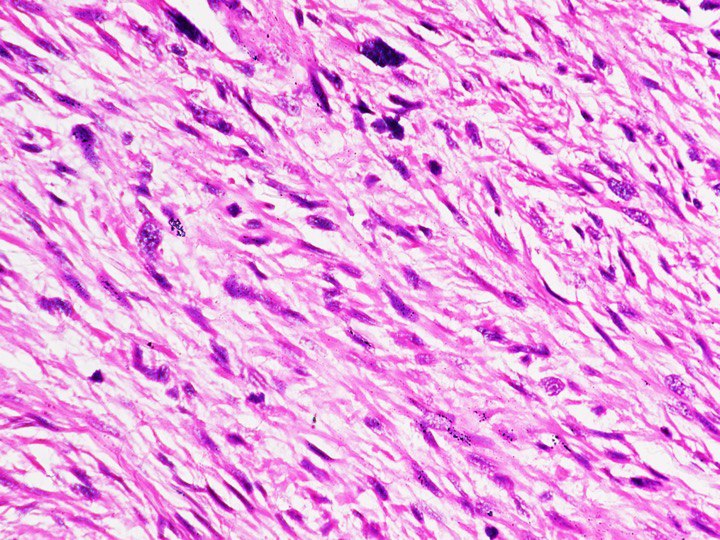 Haematoxylin & Eosin (H&E, 400X) section is composed of tumour cells in fascicles showing moderate pleomorphism, hyperchromatic to vesicular chromatin with prominent nucleoli and brisk mitosis.