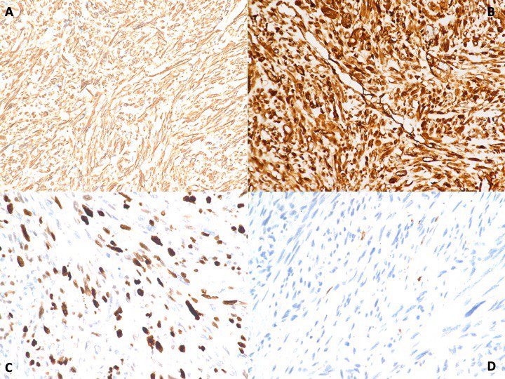 D (400X): [A& B]: SMA &Desmin IHC highlights the diffuse cytoplasmic positivity in the spindle cells; [C]: Brisk mitosis is seen with proliferative IHC marker Ki67; [D]: The atypical spindle cells are negative for S-100.