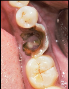 Clinical Occlusal view of the non-restorable tooth 36 with furcation involvement.