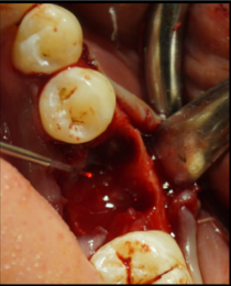 Socket debridement and curettage via diode laser (Epic X,Biolase)