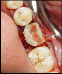 Collagen membrane (Periocol) stabilization viatucking in the buccal flap.
