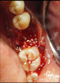 Bone graft (OsteonII Dentium, Korea) condensation in the extraction socket via bone graft carrier and condense.