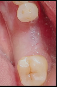 Augmented site tooth region 12 weeks post-op.