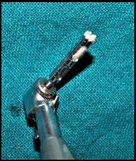 Bone core collected via trephine drill during implant placement.