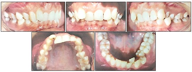 Pretreatment intraoral photographs