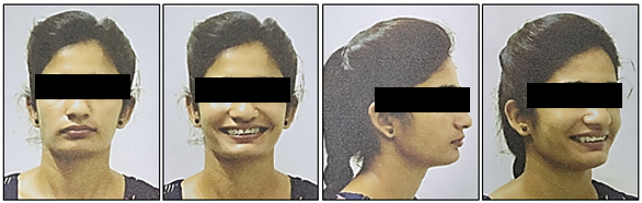 Mid treatment extraoral photographs