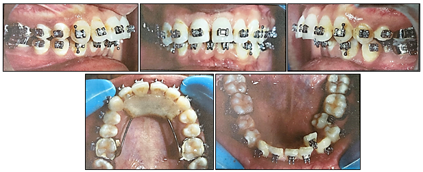 Mid treatment intraoral photographs
