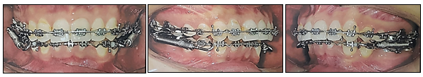 Forsus fatigue resistance appliance