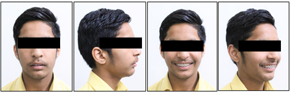 Mid treatment extra-oral photographs