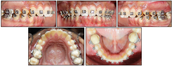 Mid treatment intra-oral photographs