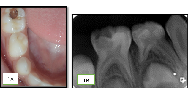 A: Intraoral photograph; B: IOPA of right primary mandibular 2nd molar