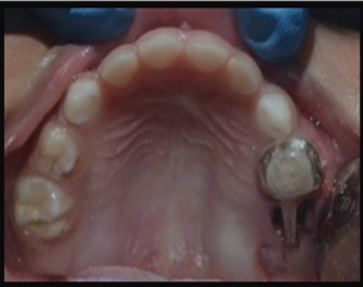Placement of distal shoe appliance