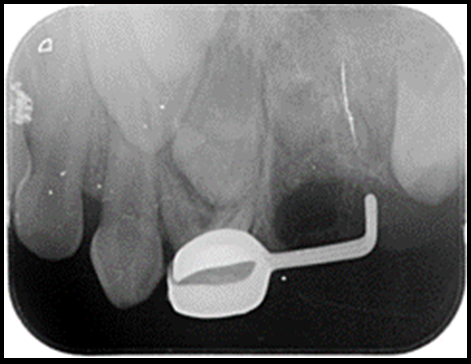 IOPA depicting position of distal shoe