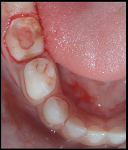 Minimal tooth preparation
