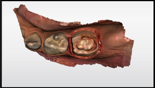 Intraoral scan